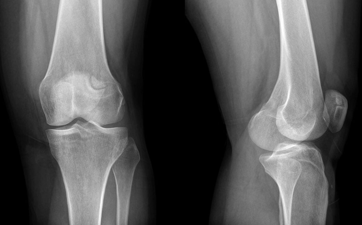 Artroza genunchiului pe x -ray înainte de utilizarea hondroinei
