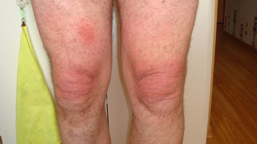 Artroza articulațiilor genunchiului